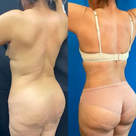 Resultado antes y después de lipoabdominoplastia, paciente del Dr. Patricio Canepa en Querétaro