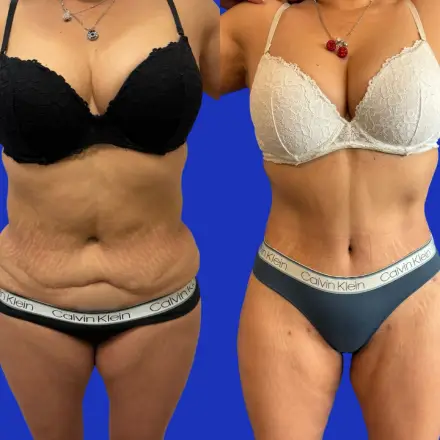 Vista frontal del resultado de lipoabdominoplastia en un paciente del Dr. Patricio Canepa, Querétaro