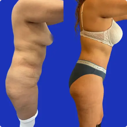 Vista de perfil del resultado de lipoabdominoplastia en un paciente del Dr. Patricio Canepa, Querétaro